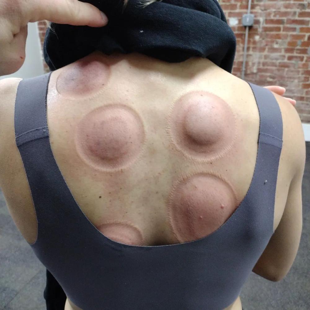 Photo of a client's back after cupping therapy at Frenchtown Chiropractic in St Charles, Missouri