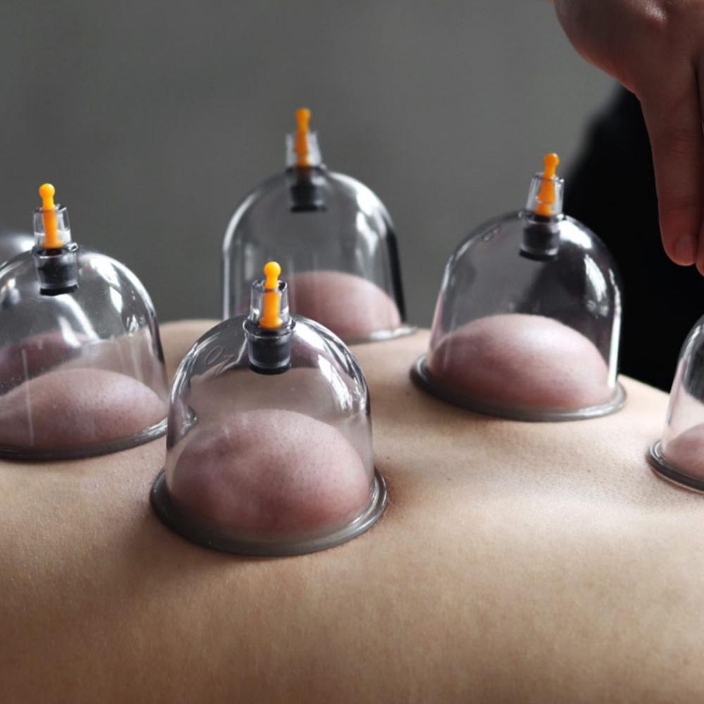 Photo of cupping therapy with stationary cups on a man's back