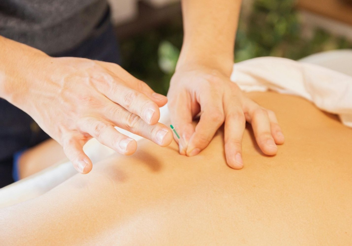 Photo of dry needling to a patient's back